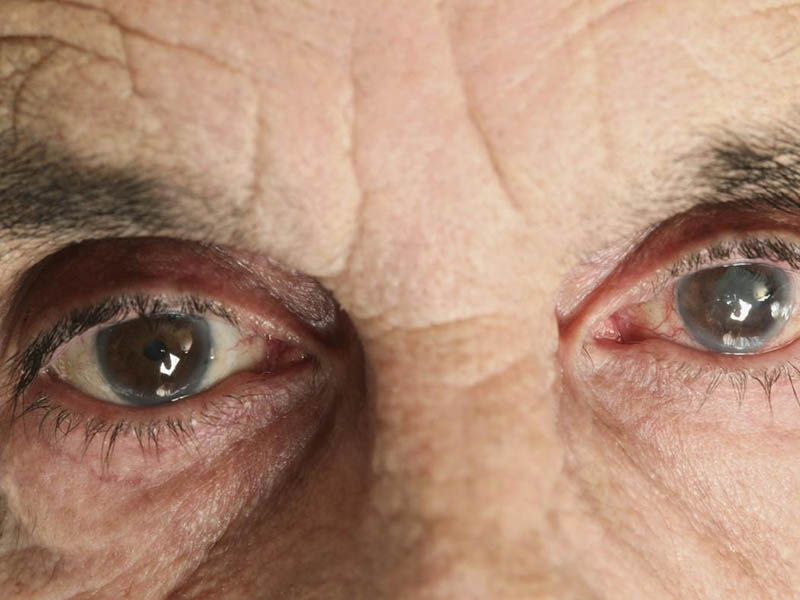 Костанай больницы клиники катаракта глаза лечение операция