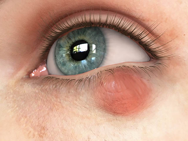 Костанай больницы клиники катаракта глаза лечение операция