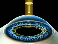 Клиника лазерной коррекции зрения саратов прейскурант