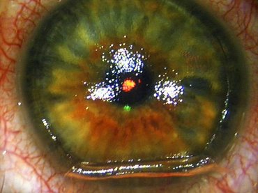 Пятигорск лазерная хирургия глаз
