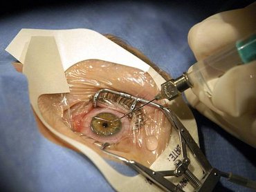 Пятигорск лазерная хирургия глаз