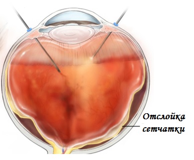 Современная инвазивная витрэктомия операция на глаза клиника расческова