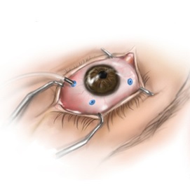 Современная инвазивная витрэктомия операция на глаза клиника расческова