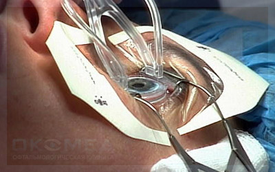 Клиника микрохирургии глаза коновалова в москве