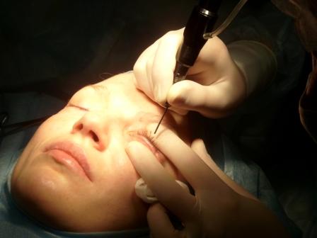 Лазерная операция глаз махачкала