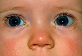 Клиника лечения нагноения глаз у детей в оренбурге