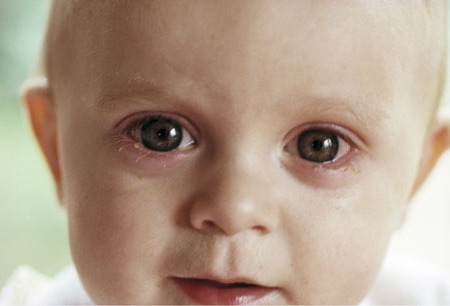 Клиника лечения нагноения глаз у детей в оренбурге