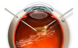 Лазерное лечение глаза стоимость в уфе