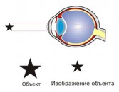 Операция на глазах от близорукости в воронеже