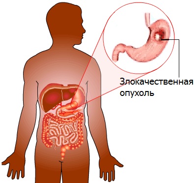 Государственная больница москва лечение опухоли печени