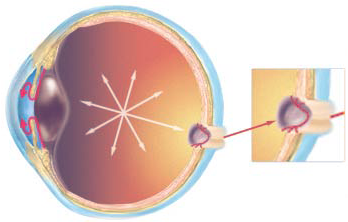 Клиника глаукомы казань вишневского 2