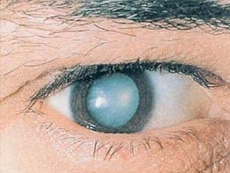 Лечение катаракты в клинике на леонова калининград