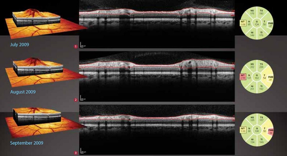 Оптическая когерентная томография диагностика недугов сетчатки зр
