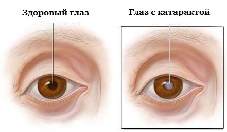 Больница федорова глазная замена хрусталика