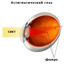 Чебоксары глазная клиника федорова смешанный астигматизм лечение