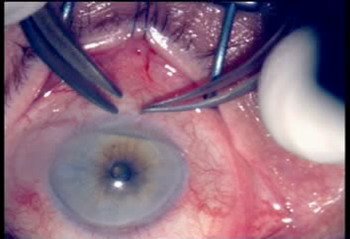 Чебоксары глазная клиника федорова микрохирургия глаза цены