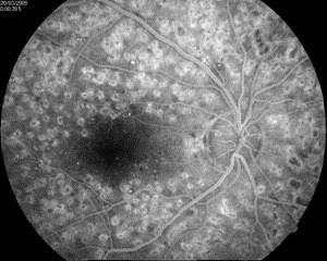Чебоксары клиника федорова лечение ретинопатии