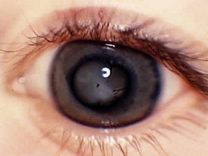 Лечение глаза в екатеринбург клиника федорова