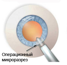 Методика всасывания хрусталика глаза клиника федорова