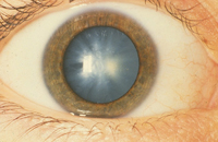 Методы лечения катаракты в институте федорова волгограда