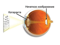 Методы лечения катаракты в институте федорова волгограда