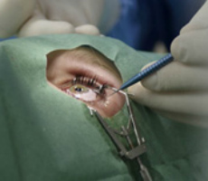 Стоимость операции по замене хрусталика глаза в клинике федорова