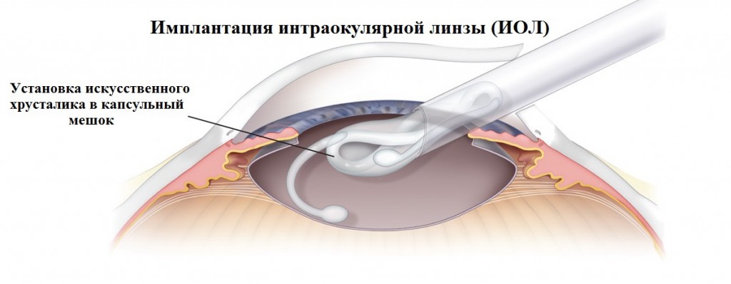 Замена хрусталика глаза клиники федорова цена
