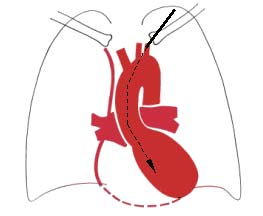 Извлечение инородное тело из сердца после катетера видео