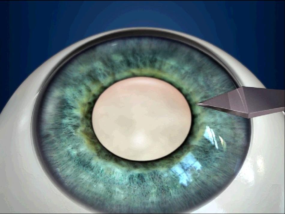 Для чего нужно снилс для лечения катаракты микрохирургия глаза имен