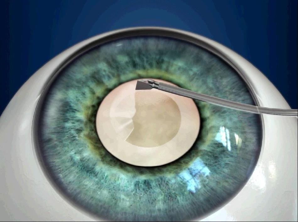 Для чего нужно снилс для лечения катаракты микрохирургия глаза имен