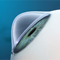 Клиника филатова одесса лазерное лечение глаз