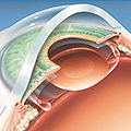 Клиника филатова одесса лазерное лечение глаз