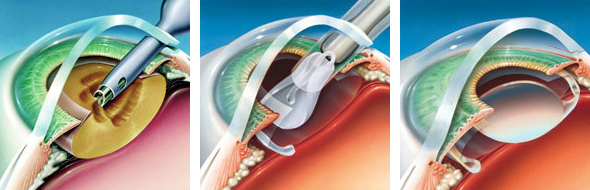 Адрес эксимер в сормове операция катаракты хрусталик
