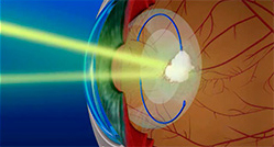Цена операции катаракты в краматорске