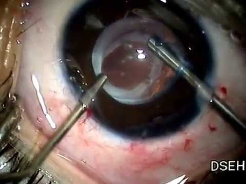 Факоэмульсификация катаракты с имплантацией иол одесса институт им филатова