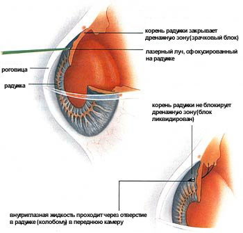 Лечение катаракты в боровлянах минск