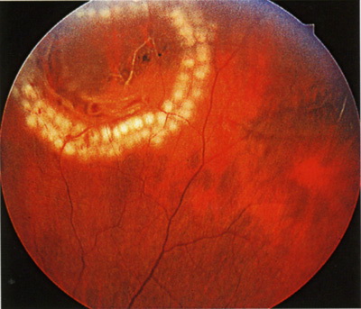 Лечение катаракты в боровлянах минск
