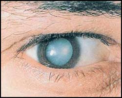 Лечение катаракты в тучково