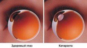 Лечение катаракты в тучково