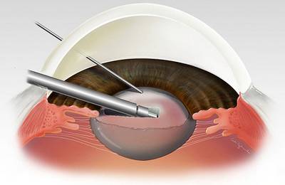 Лечение вторичной катаракты в семашко пенза