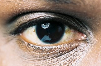 Операция по удалению катаракты в цлкзм в саратове