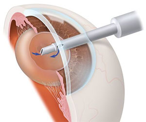 Операция по удалению катаракты в краматорске