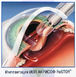 Оперативное лечение катаракты в пятигорске