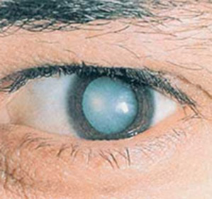 Оперативное лечение катаракты в пятигорске