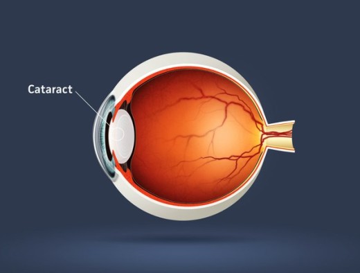 Стоимость лечения катаракты в краснодаре
