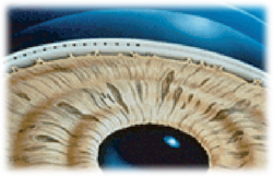 Удаление катаракты воронеж отзывы