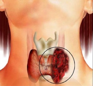 Узи щитовидки в николаеве в онкодиспансере