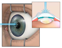Операции лазером на глазах во владикавказе