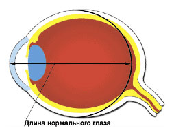 Операция на глаза миопия клиника гельмгольца