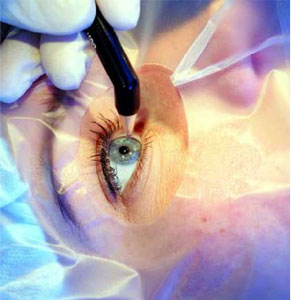 Смоленск лазерное лечение глаз